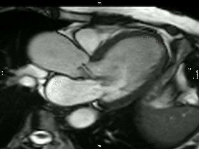 Severe aortic regurgitation