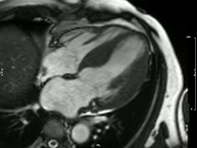 Left ventricular hypertrophy in a patient with hypertrophy cardiomyopathy