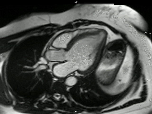 Takotsubo cardiomyopathy
