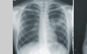 Jury still out on mitochondrial transplantation as treatment for pulmonary hypertension