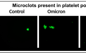 More evidence for link between blood clotting and severity of Covid-19