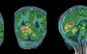 Stellenbosch University leads groundbreaking research project in paediatric Tuberculous meningitis