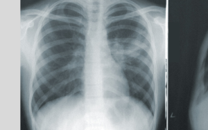 Study wants to help improve care for TB patients