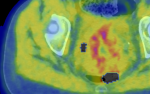 SU images tumour hypoxia in vivo