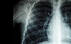 US-studie kan help om middelweerstandige TB vinniger te diagnoseer