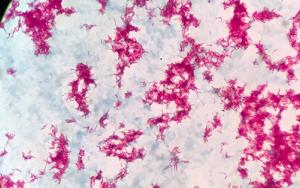 World TB Day: FMHS experts in the news