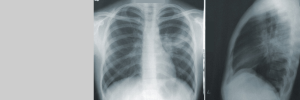 Meer navorsing nodig oor mitochondriese oorplanting as behandeling vir pulmonêre hipertensie