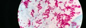 Multinational study evaluates new TB tests for diagnosis and treatment