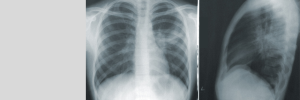 Study wants to help improve care for TB patients