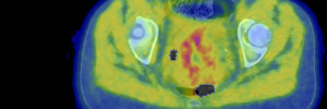 SU images tumour hypoxia in vivo