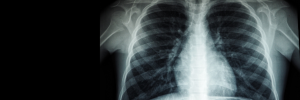 SU study aims to shorten diagnosis for drug-resistant TB