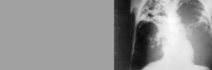 TB may remain in lungs after ‘cure’