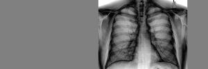 TB project gets major boost from Gates grant